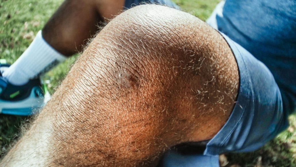 Imagen médica de rodilla con derrame articular, mostrando inflamación y tratamiento conservador.